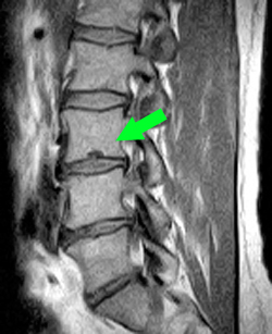 シュモール結節の腰痛 MRI画像