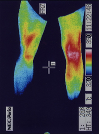 脊柱管狭窄症の足（片足の温度が低下した足）